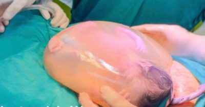 Một trong hai bé gái song sinh ‘chưa muốn’ thoát khỏi chiếc bọc ấm cúng