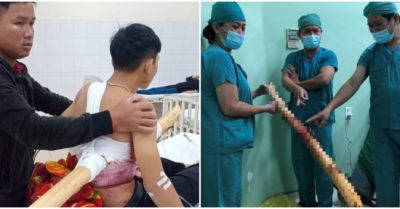 Video quá trình mổ lấy thân cây đâm xuyên người nam sinh