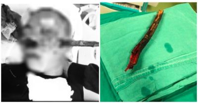 Phẫu thuật thành công cứu nam thanh niên bị cành cây đâm xuyên mặt