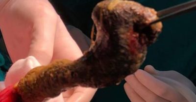 Bé gái 8 tuổi tắc ruột vì hội chứng ‘ăn tóc’