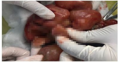 Phẫu thuật thành công cho bé gái một ngày tuổi nghi mắc thai trong thai hiếm gặp