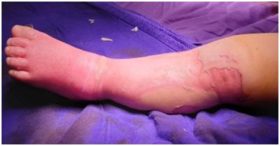 Đắp thuốc của bà lang gần nhà để chữa bỏng, bé 9 tháng tuổi không qua khỏi do sốc nhiễm khuẩn