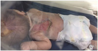 Chích mụn tại nhà bằng kim khâu, bé sơ sinh bị nhiễm trùng huyết nặng