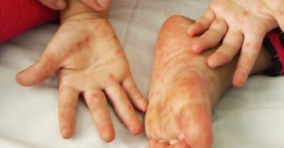 Bệnh tay chân miệng bùng phát tại Quảng Nam, Quảng Ngãi