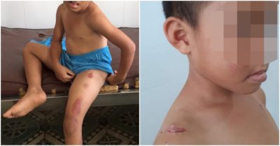 Bé trai 6 tuổi bị cha dượng đánh đập, châm thuốc lá vào người