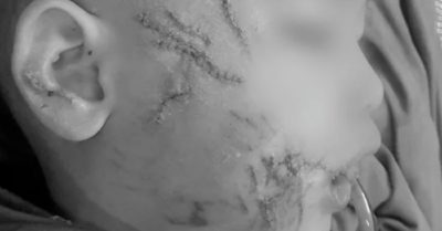 Sang nhà hàng xóm chơi, bé trai 3 tuổi bị chó tấn công