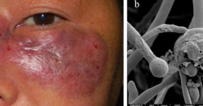 Vì sao bệnh nhân COVID-19 tiếp tục nhiễm trùng nấm đen tại Ấn Độ?
