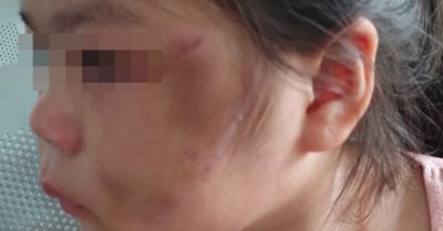 Bé gái 6 tuổi bị bố “lỡ tay” đánh bầm tím mặt trong lúc kèm học online