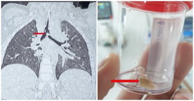 Bé 20 tháng tuổi ở TP. HCM suy hô hấp do mảnh xương cắm vào phế quản