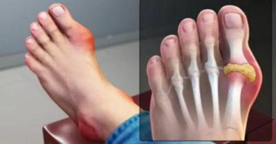 6 căn bệnh đau nhất thế giới, bệnh gút chỉ đứng thứ 5