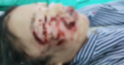 Bé gái 10 tuổi bị chó becgie đang chửa cắn rách mặt