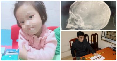 Lời khai của nghi phạm ghim đinh vào đầu bé gái 3 tuổi