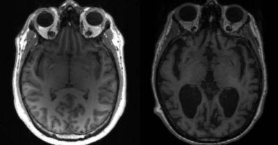 Căn bệnh thần kinh kỳ lạ ập đến với những người Canada trẻ tuổi