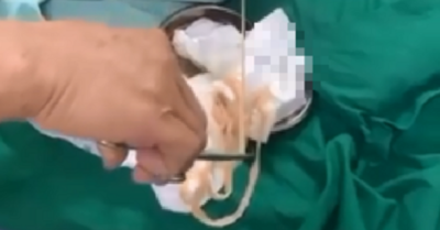 Nội soi dạ dày người phụ nữ hay ăn đồ tái sống phát hiện con sán dây dài 6m