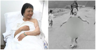 “Em bé Napalm” được điều trị da lần cuối sau 50 năm