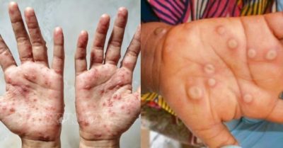 TP.HCM phát hiện ca mắc đậu mùa khỉ đầu tiên