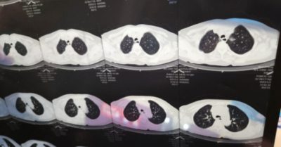 ‘Lá phổi trắng’ tràn ngập mạng xã hội Trung Quốc trong bối cảnh ca nhiễm COVID tăng đột biến