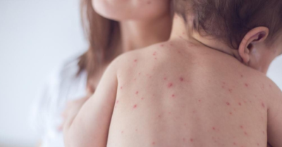 Bệnh sởi lây lan nhanh: Bộ y tế hướng dẫn phòng chống dịch hiệu quả
