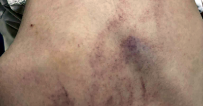 Điều tra vụ bé gái 4 tuổi nghi bị giáo viên bạo hành ở Hà Nội