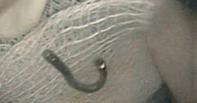 Bé trai 5 tuổi nuốt móc dây chuyền bạc phải nhập viện cấp cứu