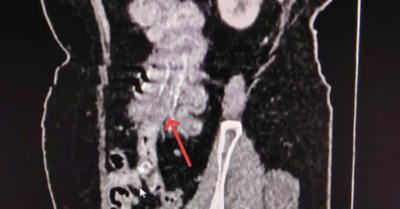 TP.HCM: Khẩn cấp cứu 2 phụ nữ mang khối u ác tính ở ruột và xương sọ