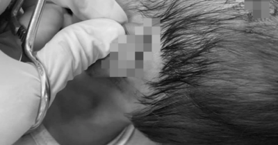 Bé gái 19 tháng tuổi ở Huế bị chó dữ tấn công, phải tiêm huyết thanh kháng dại