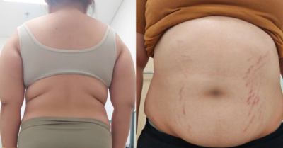 Bé gái 14 tuổi mắc hội chứng Cushing: loãng xương, cao huyết áp, sỏi thận, béo phì