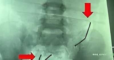 Trẻ nuốt nam châm: Thủng ruột nguy hiểm