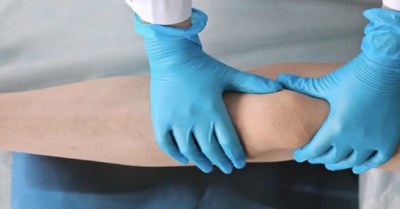 Phẫu thuật giảm chiều cao: Giải pháp cho tự ti