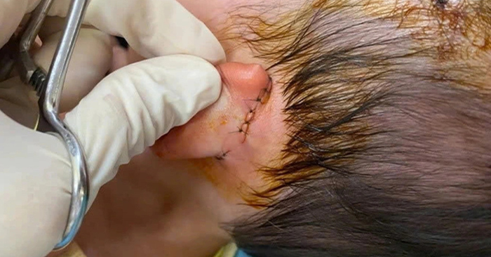 Bé gái bị chó cắn ở Huế nhập viện cấp cứu