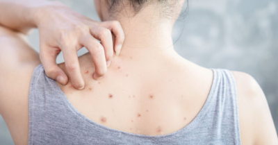 Trị mụn lưng nhanh với thói quen đơn giản