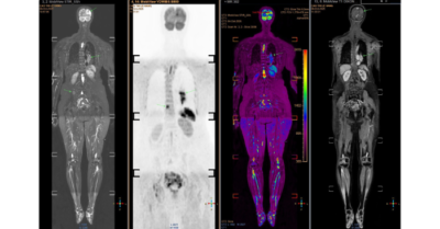 Ung thư giai đoạn cuối vì hít khói thuốc từ chồng con