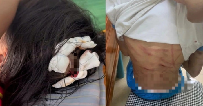 Bé gái lớp 5 nghi bị bố dượng bạo hành