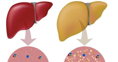 Gan nhiễm mỡ: Những nhóm người dễ mắc và cách phòng tránh hiệu quả