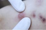 Nguy cơ hoại tử sau tiêm tan mỡ tại cơ sở làm đẹp không phép