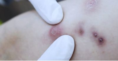 Nguy cơ hoại tử sau tiêm tan mỡ tại cơ sở làm đẹp không phép