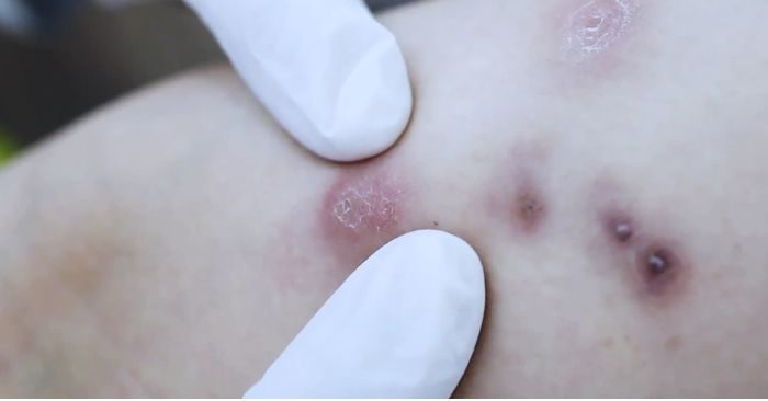 Nguy cơ hoại tử khi tiêm tiêu mỡ