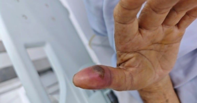 Người đàn ông bị rắn lục đuôi đỏ cắn ngay trong nhà vệ sinh lúc vừa thức dậy