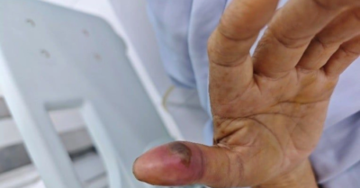 Rắn độc “nấp” trong nhà vệ sinh cắn người vừa ngủ dậy