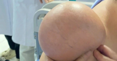 Người đàn ông mang khối u khổng lồ trên vai suốt 5 năm được phẫu thuật thành công