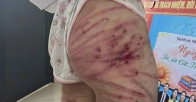 Xác minh vụ bé gái nghi bị cha dượng bạo hành dã man tại Hà Tĩnh