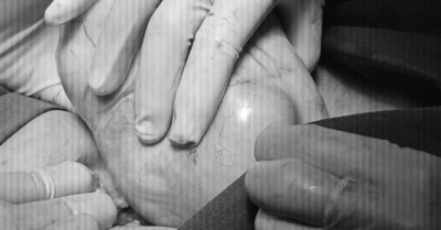 Phẫu thuật thành công khối u nang buồng trứng gần 2kg tại Quảng Trị