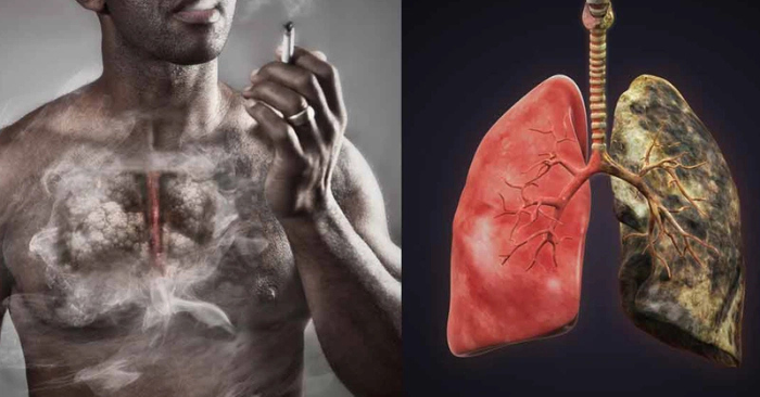 Tác hại thuốc lá với ung thư phổi tại Việt Nam