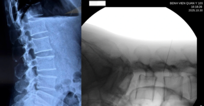 Dị vật 6cm “mắc kẹt” trong thắt lưng do tự châm cứu