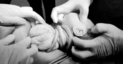 Cảnh báo nguy cơ dây rốn quấn cổ và tiền sản giật ở thai phụ