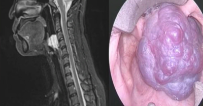 U máu thanh quản “siêu hiếm” – chỉ một sai sót nhỏ, tính mạng nguy