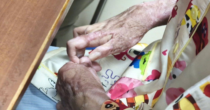 thiếu nữ 17 tuổi bị bỏng do keo nến