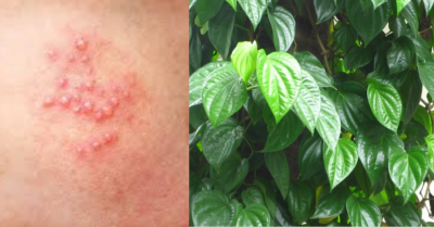 Zona thần kinh và bí quyết trị khỏi từ trầu không