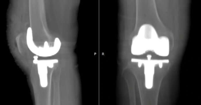 thay khớp gối công nghệ 3D