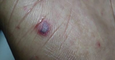 Báo động não mô cầu – Căn bệnh tử thần dễ nhầm với cảm cúm